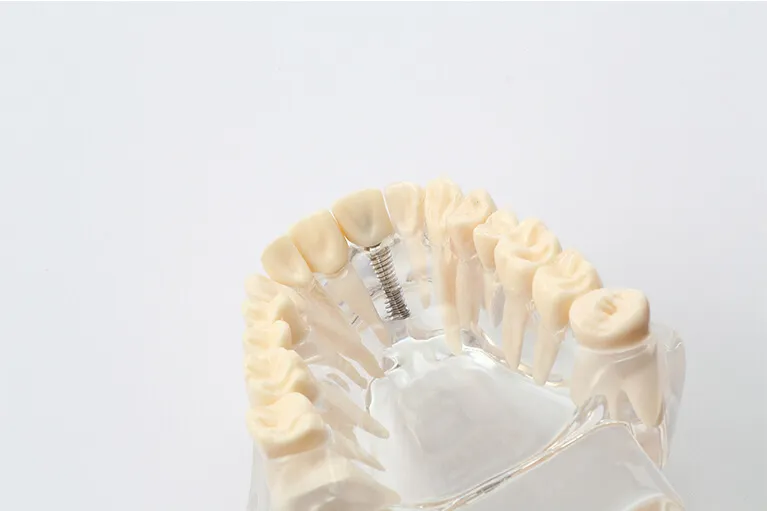 3 インプラント体に歯を装着